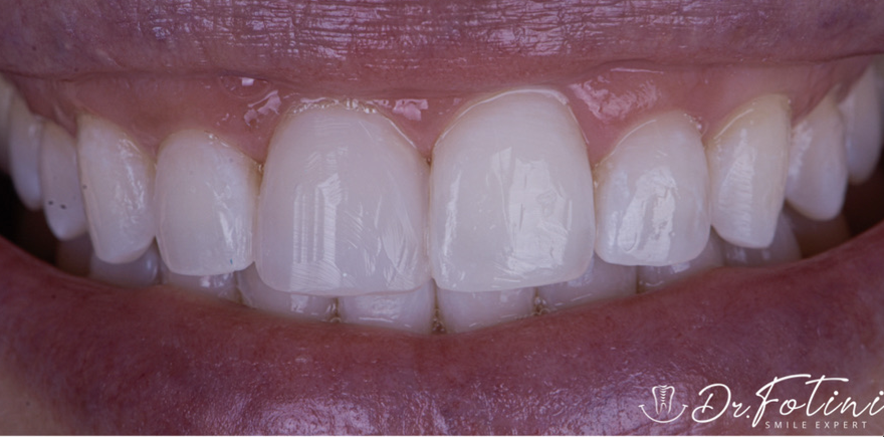 Cosmetic Bonding Teeth Whitening For Central Incisor - After