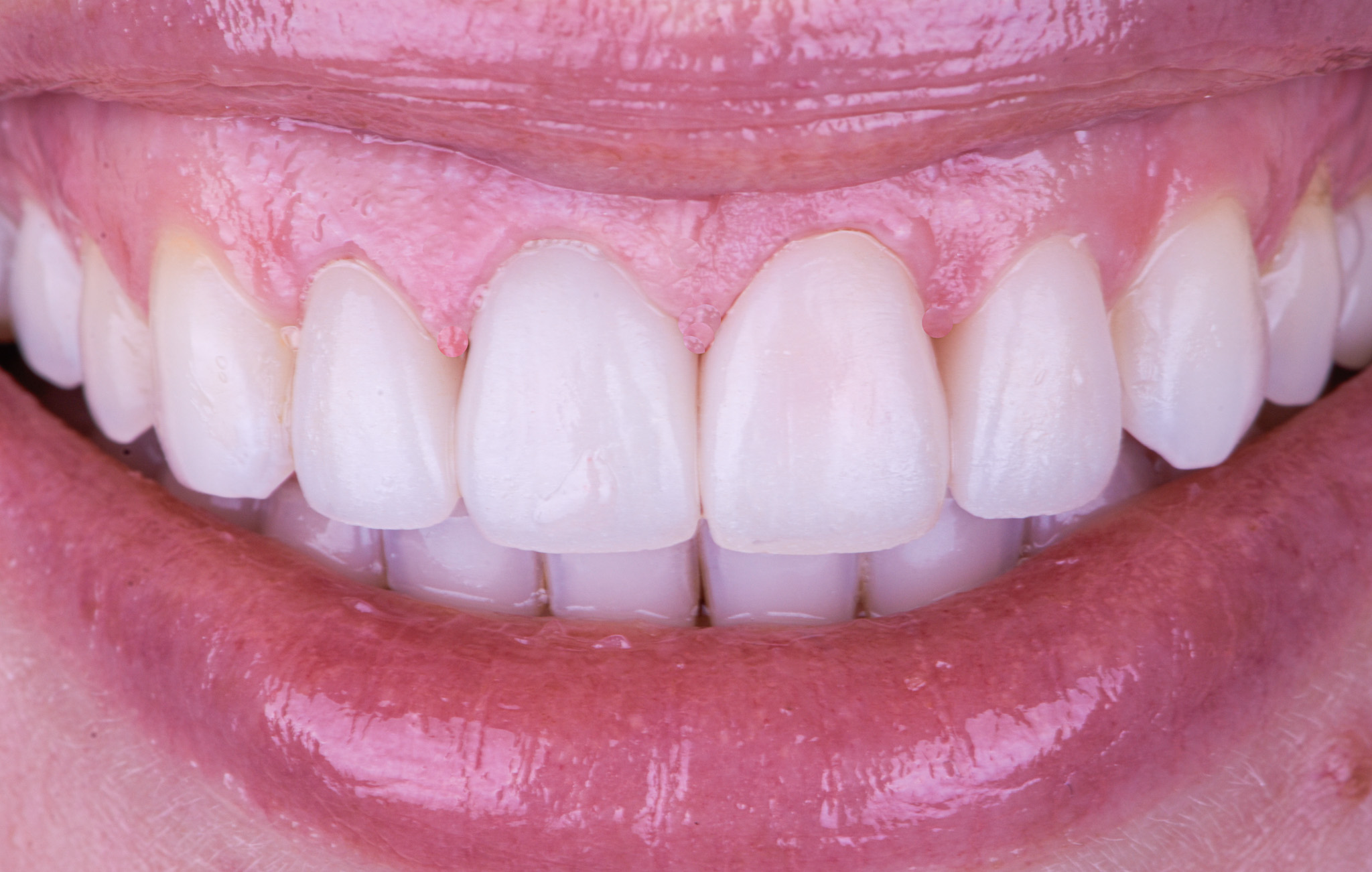 Porcelain Crowns Veneers With Gum Recountouring - After
