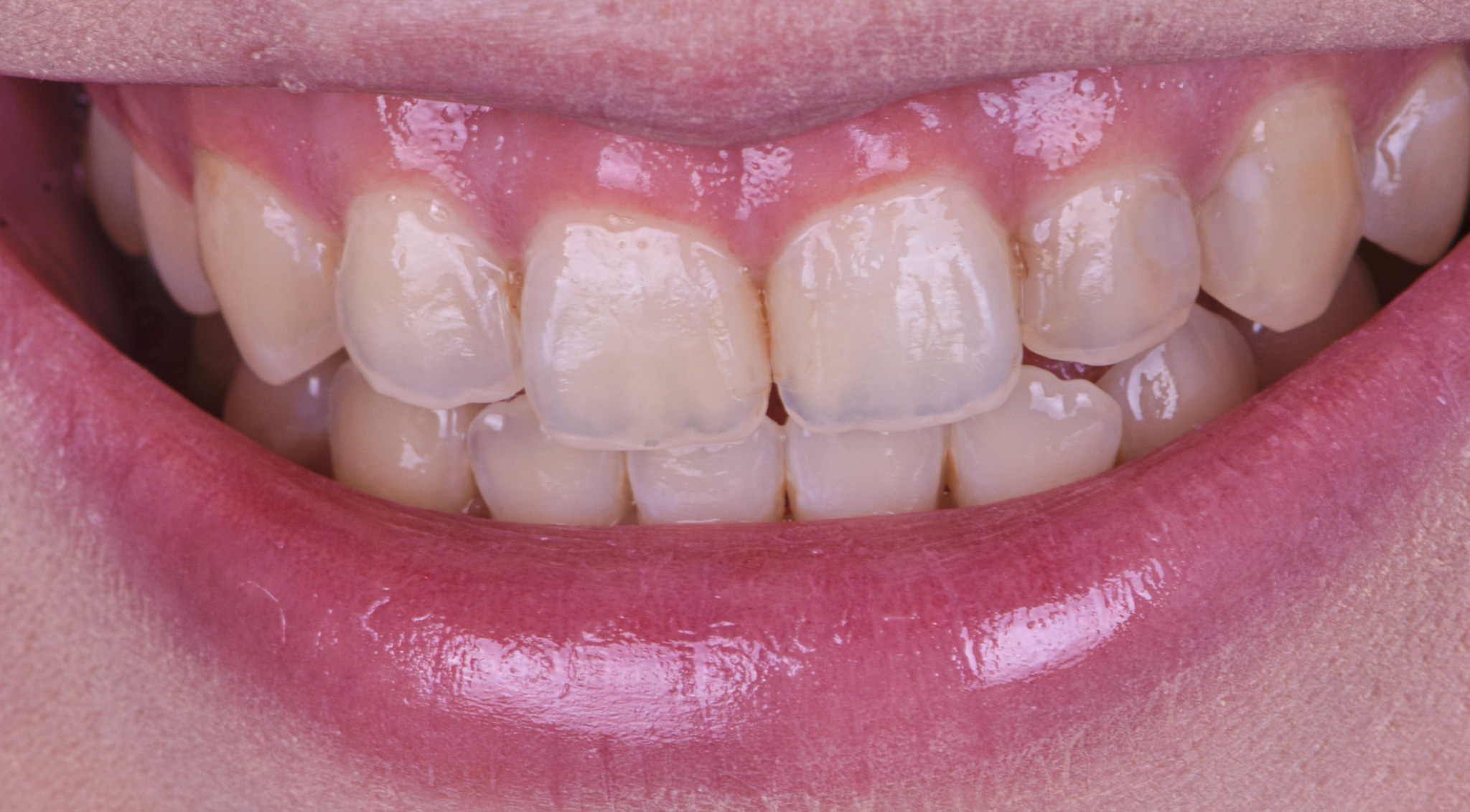 Porcelain Veneers And Laser Gingiva Recontouring To Correct Discoloration And Gummy Smile - Before