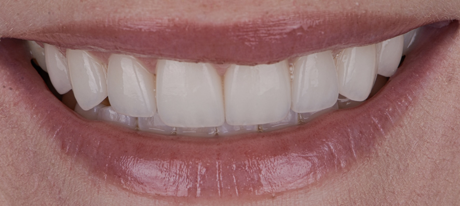 Smile Makeover With Porcelain Veneers - After