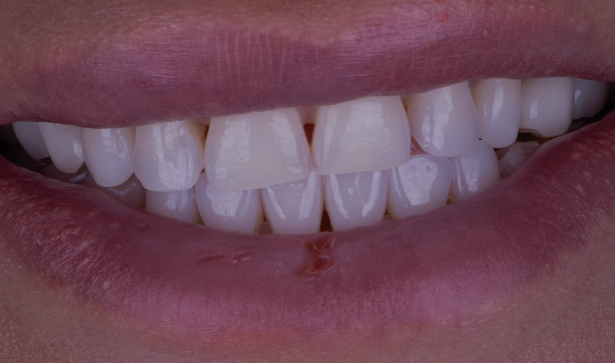 Smile Mock Up Based On Digital Smile Design - Before